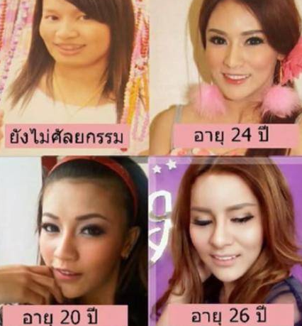 泰国女子因为太丑被人欺负，赴韩整容10多次大变身