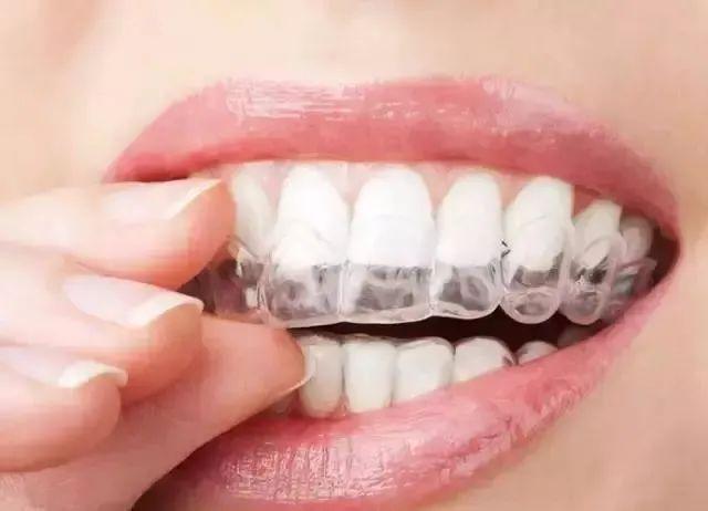 想做牙齿矫正，却一无所知？盘盘口腔正畸中的那些矫治器优缺点