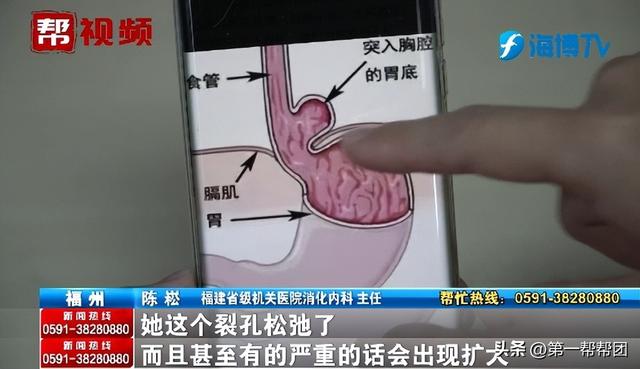 女子长期恶心、反酸,竟因胃跑入胸腔?医生:这个作息习惯很不好
