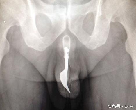 尿道自插导尿管、笔芯、筷子等异物，引发的治疗迷思！