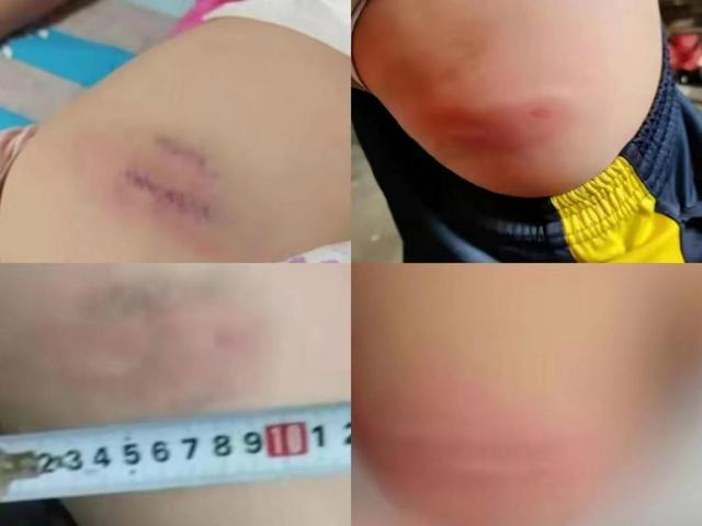 13岁学生因未完成作业,屁股被老师打开了花!警察:不违法