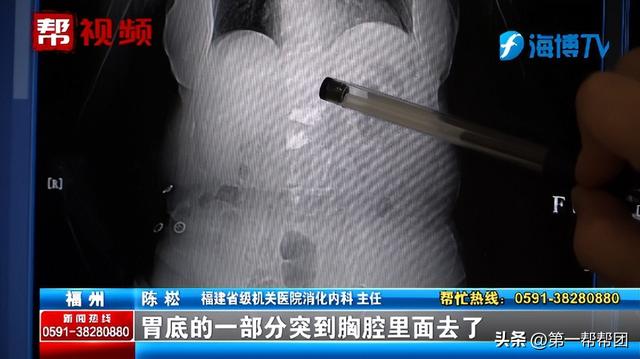 女子长期恶心、反酸,竟因胃跑入胸腔?医生:这个作息习惯很不好